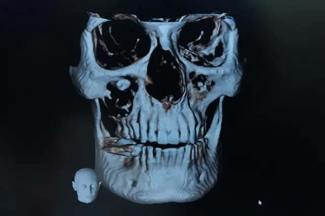 आंख में दांत