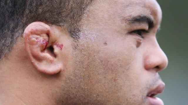 El jugador profesional de rugby Sam Talakai con orejas de coliflor sangrantes.