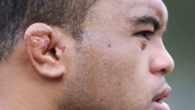 O jogador profissional de rugby Sam Talakai sofreu sangramento nas orelhas de couve-flor em 2018