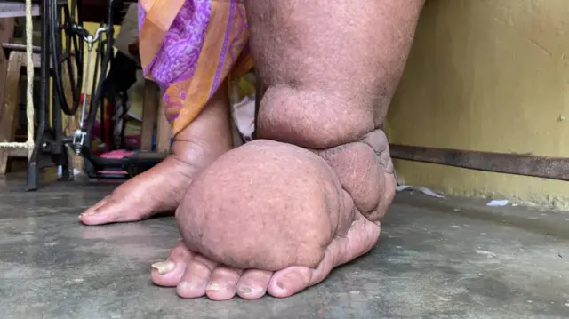 हत्तीरोग
