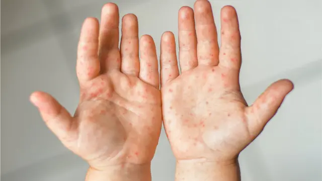 टोमॅटो फ्लू