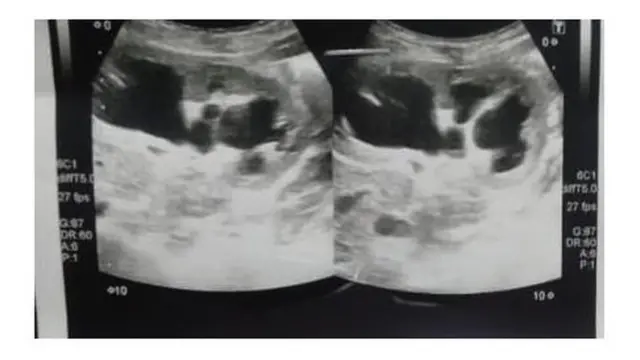 Une échographie de l'abdomen de la petite Shazia