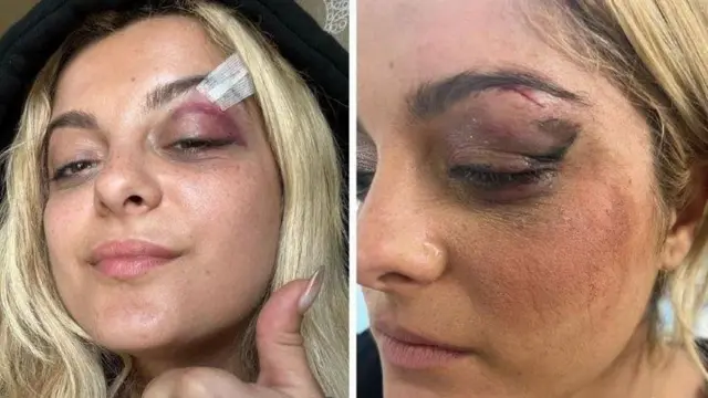 Bebe Rexha alionesha majeraha yake kwenye ukurasa wa Instagram