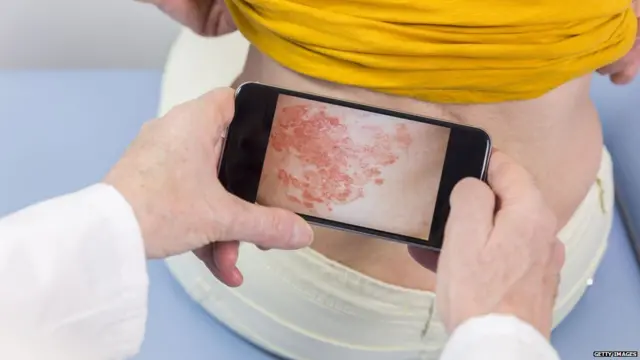 ਸੋਰਾਸਿਸ