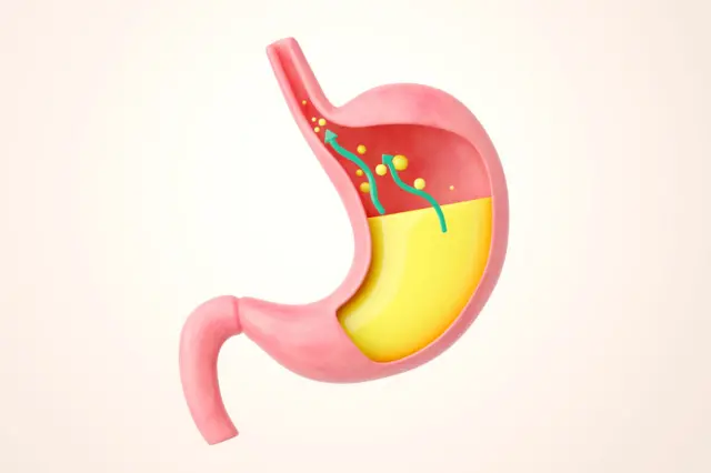 GERD म्हणजे काय? कधीतरी होणारी असिडिटी आणि त्यात काय फरक आहे?