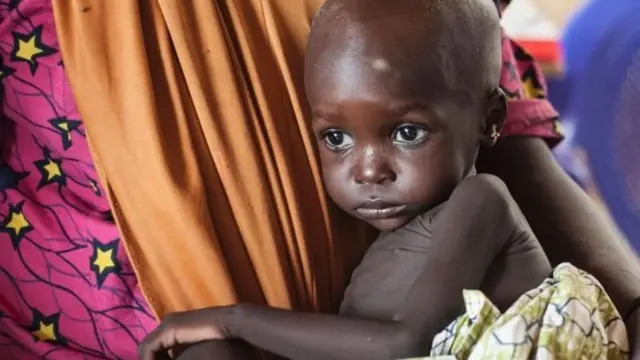 Yarinya na fama da rashin abinci mai gina jiki