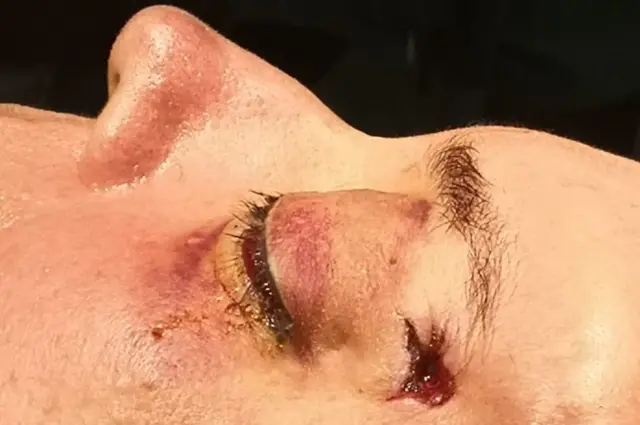 La bala le entró por la sien izquierda y tuvieron que sacarla por el pómulo derecho.