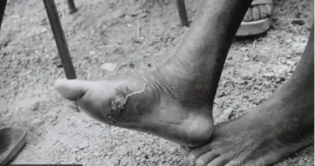 Guinea worm