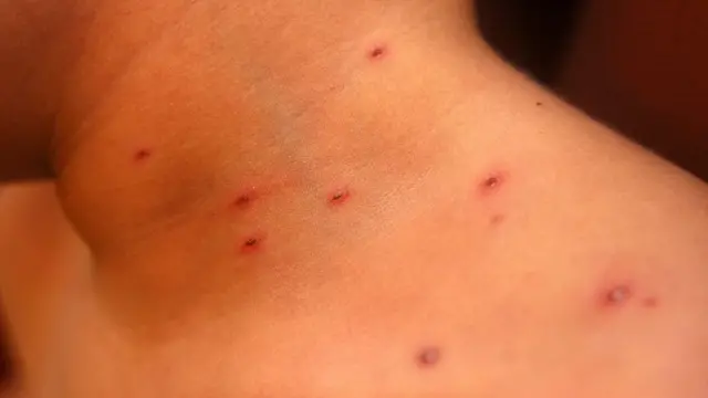 Un enfant atteint de la varicelle.