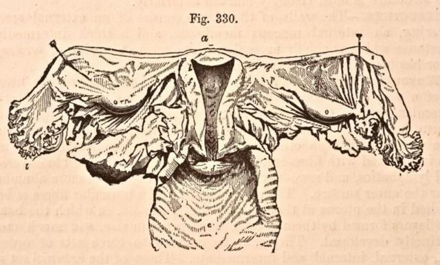 Em 1876, data desta gravura, a anatomia de um útero era um pouco mais clara e já se sabia que ele não vagava pelo corpo.