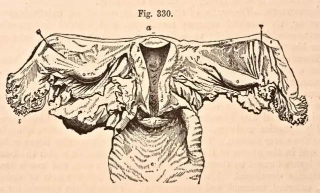 Em 1876, data desta gravura, a anatomiacbet argentinaum útero era um pouco mais clara e já se sabia que ele não vagava pelo corpo.