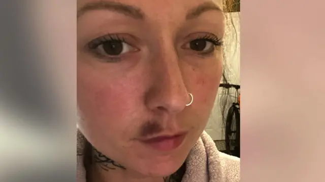 Picture of a person who had complications after a lip filler procedure