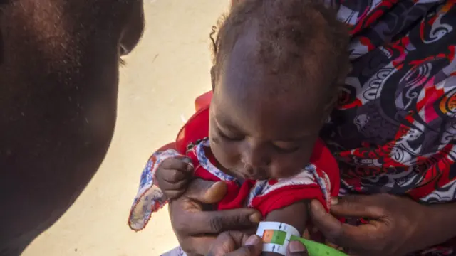 O braço de uma criança refugiada sudanesa que sofre de desnutrição é examinado por um médico no hospital criado pela ONG Médicos Sem Fronteiras (MSF).