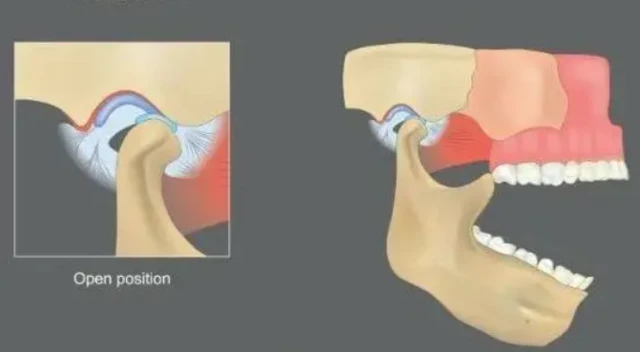 ਟੈਂਪੋਰੋਮੈਂਡੀਬਿਊਲਰ ਜੋੜ ਡਿਸਲੋਕੇਸ਼ਨ (ਟੀਐਮਜੇ) ਦਾ ਪ੍ਰਤੀਕਾਤਮਕ ਚਿੱਤਰ