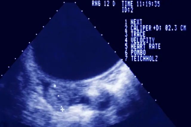 Ecografia mostrando uma gravidez extrauterina