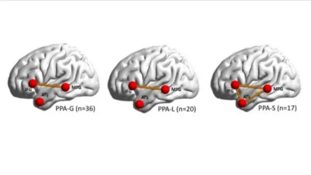 تصویر سه ناحیه مغز که در تولید کلام معنادار نقش دارند