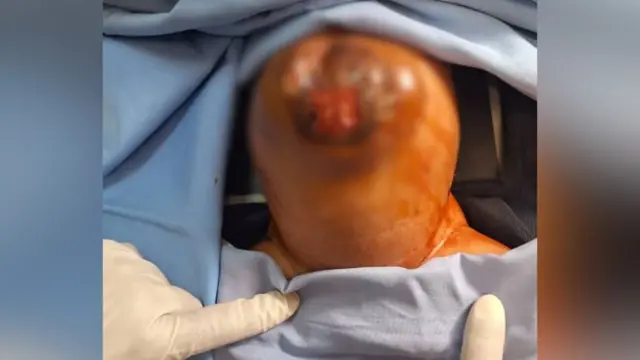 የሆድ እቃ ክፍተት ያጋጠመው ጨቅላ ቦቶክስ ከተሰጠው በኋላ