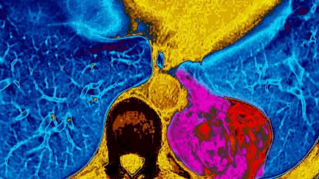 Bizi xəstəliklərdən qoruya bilmədiyi kimi, bir tədqiqat nəticəsində bəlli olub ki, vitaminlər siqaret çəkənlər üçün ciyər xərçəngi riskini artırır