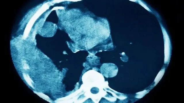 Foto of Lung cancer (cancerous tumor wey carry group of cancerous cells wey don enta nearby tissues and destroy dem, dem fit also spread in metastases). Na thoracic scanner for radial section visualise di lungs.