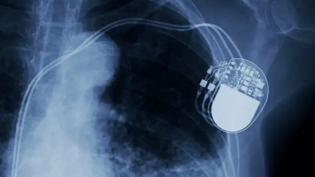 বুকের এক্সরে