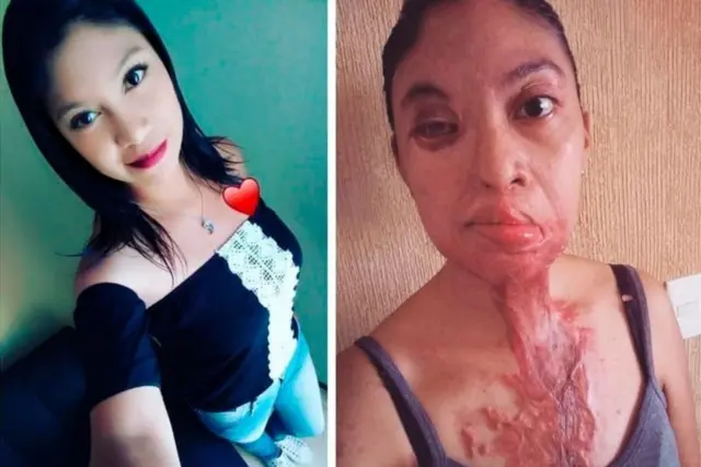 ઍસિડહુમલાની પીડિતા