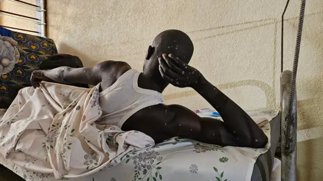 Umurwayi wa Mpox mu kigo kibavura mu bitaro Roi Khaled mu Kamenge, ku wa 22 Myandagaro mu 2024