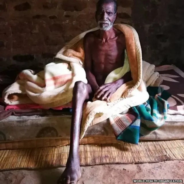 সাপের কামড়ের ফলে অনেকের অঙ্গ প্রত্যঙ্গ কেটে ফেলতে হয়।