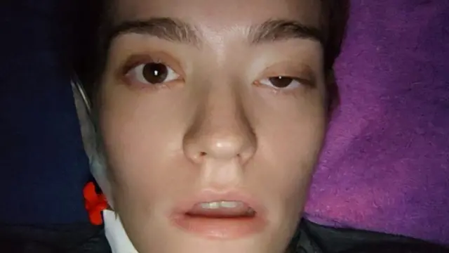 Carolina com metade do rosto paralisado aps a ltima cirurgia