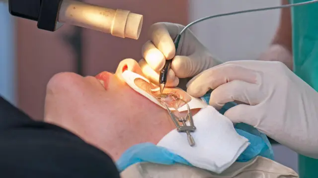 ਲੇਸਿਕ ਸਰਜਰੀ