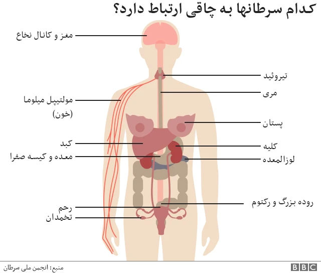 چاقی 'بیشتر از سیگار' باعث ابتلا به انواع سرطان میشود