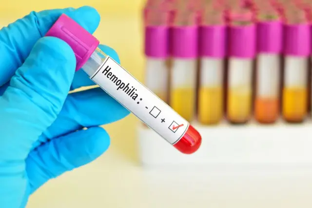 Muestra de sangre de un paciente con hemofilia.