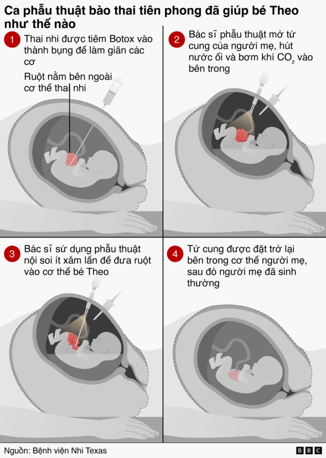 Đồ họa thông tin minh họa quy trình phẫu thuật trước sinh gồm bốn bước. Thai nhi được tiêm Botox vào thành bụng để làm giãn cơ; các bác sĩ phẫu thuật tạm thời mở tử cung và sử dụng phẫu thuật nội soi ít xâm lấn để đưa ruột của thai nhi trở lại bên trong cơ thể trước khi đặt lại tử cung, cho phép thai kỳ tiếp tục cho tới khi em bé khỏe mạnh được sinh ra tự nhiên.