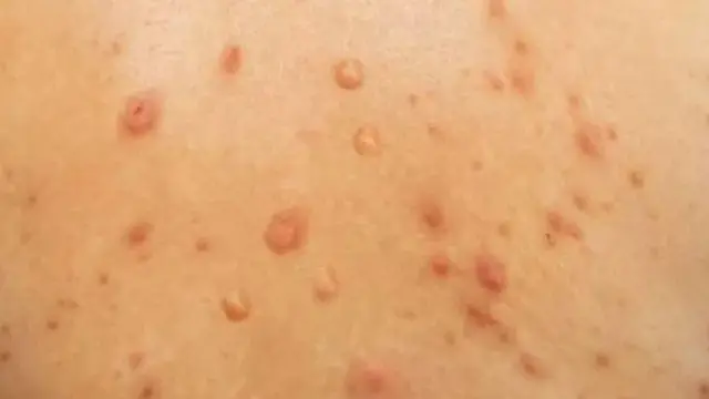 Ọrịa Monkey Pox efesala gaa ọtụtụ mba ụwa na 2022 karịa etu o si efesa na mbụ