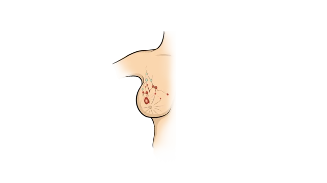 چ﻿ھاتی کا کینسر