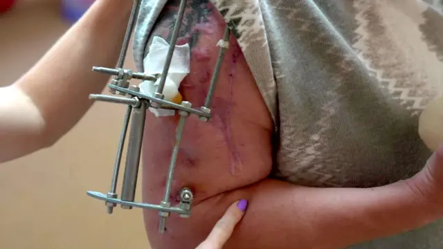 ратни ветерани, повреде, ране