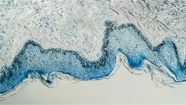 Le diagnostique de la lèpre