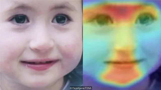 我们的面部特征可能泄露某些罕见遗传疾病的微妙信息，机器学习正在帮助医生识别这些特征。