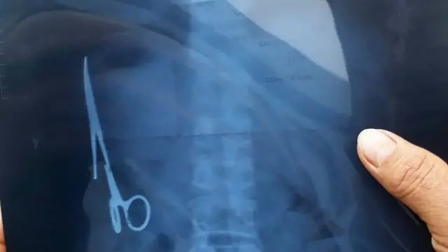 قیچی‌ای که در شکم یک بیمار در ویتنام جا مانده بود