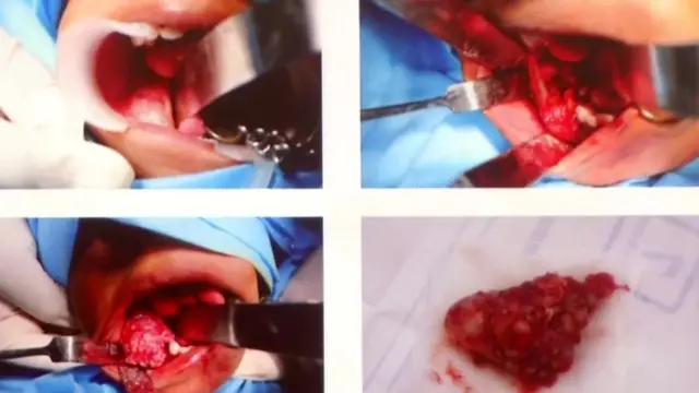 Operasi pengangkatan lebih dari 500 gigi berlangsung sekitar empat sampai lima jam.