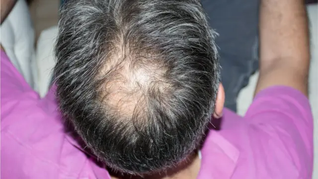 পুরুষদের অ্যালোপেশিয়া