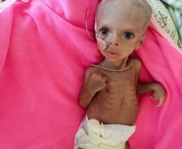 Surafeal Mearig is among the many children who are suffering because of the conflict