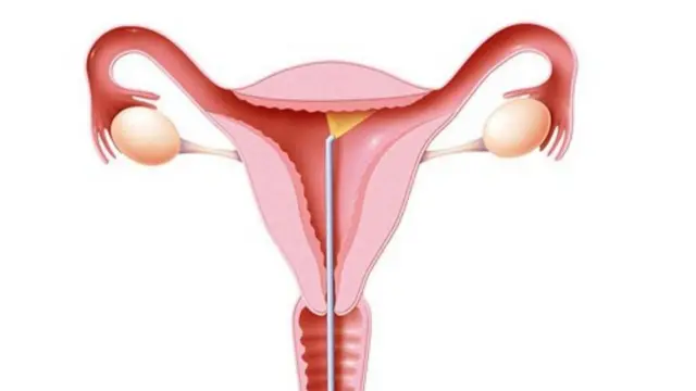 అధిక రక్తస్రావానికి ఆపరేషన్ అవసరం లేని చికిత్స అందుబాటులో ఉన్నాయి