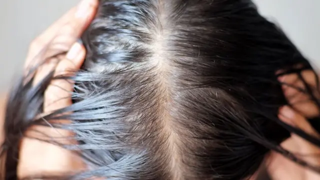 Una cabeza con pérdida de cabello