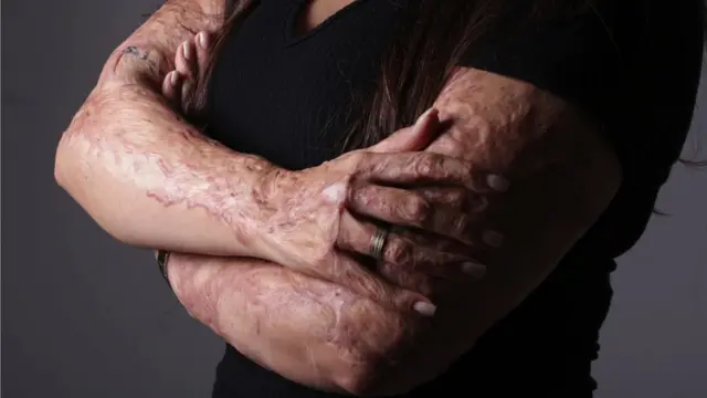 The scarred arms of Kelen Fereira