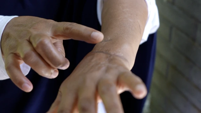 Akibat serangan itu, tangan kiri Sariah kini cacat. Dadanya juga disebut penuh dengan bekas luka.