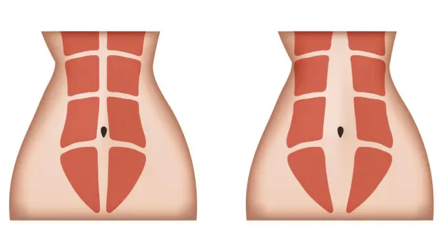 पोटाची सामान्य स्थिती आणि डायस्टॅसिस रेक्टीमध्ये झालेला बदल