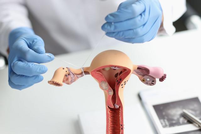  montrant la stérilisation féminine
