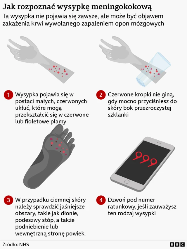 Infografika zatytułowana „Jak rozpoznać wysypkę meningokokową”. Wyjaśnia, że ​​wysypka może być objawem zakażenia krwi wywołanego zapaleniem opon mózgowych. Grafika przedstawia ramię z małymi czerwonymi, ukłutymi punkcikami. W kroku 1 zaznaczono, że wysypka pojawia się w postaci maleńkich czerwonych kropek, które mogą przekształcić się w czerwone lub fioletowe plamki. Krok 2 ilustruje przezroczyste szkło dociskane do wysypki, a tekst informuje, że plamki nie bledną pod naciskiem. Krok 3 przedstawia ramię o ciemnym odcieniu z wyróżnionymi obszarami, sugerując, że na ciemniejszej skórze wysypkę najlepiej sprawdzać w jaśniejszych miejscach, takich jak dłonie, podeszwy stóp, podniebienie lub wewnętrzna strona powiek. Krok 4 przedstawia telefon z numerem „999” i instrukcją natychmiastowego wezwania pogotowia ratunkowego w przypadku wystąpienia tego rodzaju wysypki. Źródło: NHS