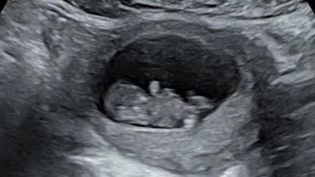 Um ultrassom fetal com imagem em preto e branco