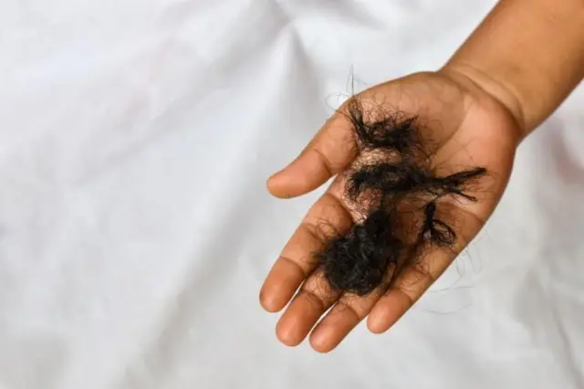 முடி உதிர்தல் பிரச்னை, கட்டுக்கதையும் உண்மையும்